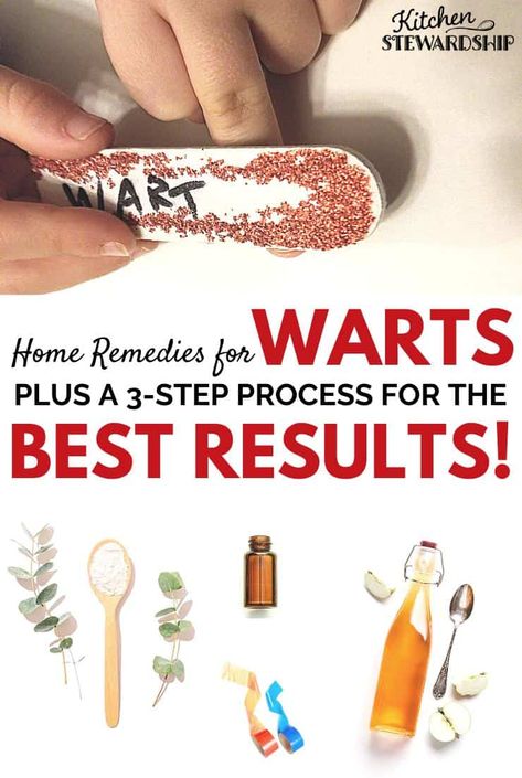 Home remedies for warts that are simple, natural, and cost-effective. Plus the three-step process that gets the best results! Remove warts naturally with these simple techniques put to the test by a real family. Home Remedy For Warts, Filiform Wart, Face Warts, Natural Wart Remedies, Types Of Warts, Warts On Face, Home Remedies For Warts, Warts Remedy, Remove Warts