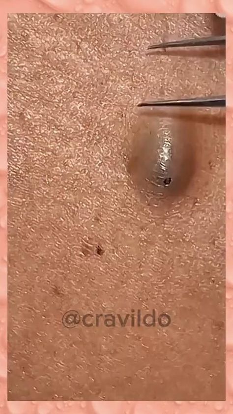 #blackheadspopping #blackheadremoval #blackhead #facial #skincare Please re-pin 😍💞 Exclusive Creams Await You! 📌 silicone patches for stretch marks reddit, blackheads back youtube, blackheads whiteheads removal peel off mask 😍 #glowingskin #drugstorecosmetics #puffiness Pore Extraction Video, Blackheads Removal Satisfying Videos, Black Head Removal Video Nose, Pimple Poppìng, Blackhead Popping, Huge Blackheads, Laser Stretch Mark Removal, Whiteheads Removal, Big Zits