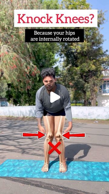 How To Fix Knock Knees, How To Get Rid Of Knock Knees, Knock Knees Exercises, Knock Knees, Yoga For All, Knee Exercises, Hip Openers, April 6, Yoga Girl