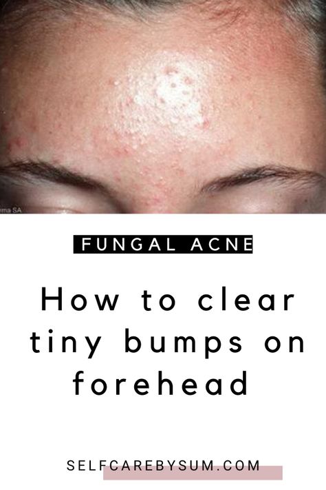 Generated Description with relevant hashtags. Tiny Bumps On Forehead, Get Rid Of Fungal Acne, Forehead Pimples, Bumps On Forehead, Forehead Breakout, Nizoral Shampoo, Small Bumps On Face, Nails Remedies, Forehead Bumps