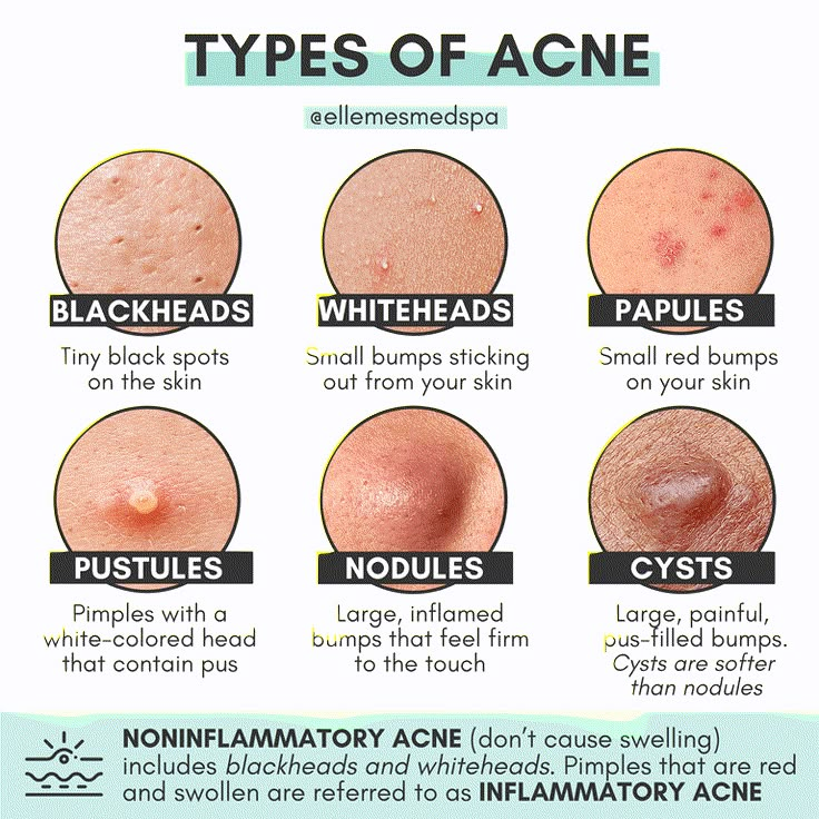 Skincare For Combination Skin, Different Types Of Acne, Haut Routine, Skin Facts, Skin Advice, Basic Skin Care, Clear Healthy Skin, Types Of Acne, Basic Skin Care Routine