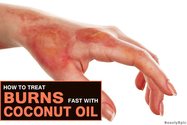 Coconut oil contains many beneficial properties that make it valuable when it comes to fighting burns. Here are 3 best ways to use coconut oil for burns. Coconut Oil For Burns, Essential Oil For Burns, Coconut Oil For Sunburn, How To Help Sunburn, Blister Remedies, Types Of Burns, Burn Remedy, Radiation Burn, How To Heal Burns