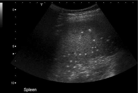 Causes of splenic calcification Category Example Infection Healed ...