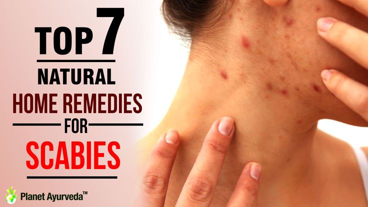 Top 7 #Natural #Home #Remedies for #Scabies  This #skin #disease is caused by tiny mites known as #Sarcoptes #scabiei. This mite is a parasite which stay in a host to live. The #female mites #burrow under the skin of a human being and lays eggs. Stomach Cramps, Things Under A Microscope, Skin Diseases, Alternative Health, Medical Prescription, Natural Home Remedies, Natural Treatments, Natural Home, Spiders