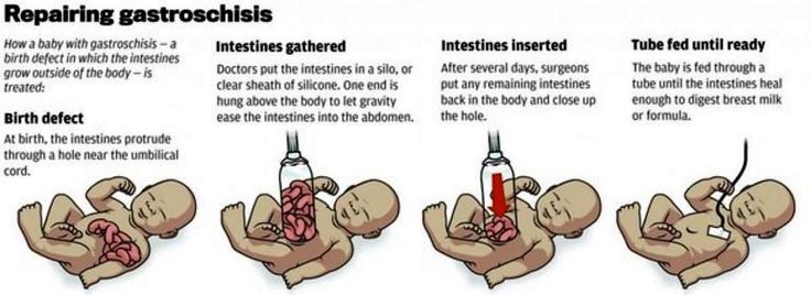 Image result for gastroschisis repair Gi Nursing, Nursing Things, Medicine Illustration, Medical Mnemonics, Preemie Baby, Preemie Babies, Medical Coding, Feeding Tube, Med School