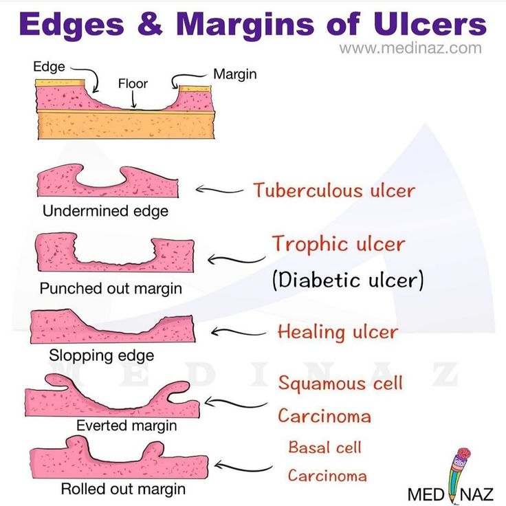 Edges and margins of ulcers Oral Pathology Notes, Nursing Tools, Wound Care Dressings, Oral Pathology, Pressure Ulcer, Basal Cell, Vascular Surgery, Medical Student Study, Medical Laboratory Science