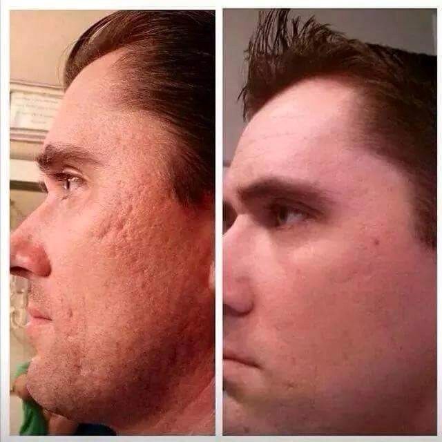 Nerium AD WILL CLEAR OUT THOSE DISTURBING CRATERS #FeelGood Acne Scar Cream, Acne Scar Removal Cream, Scar Removal Cream, Acne Overnight, Acne Scarring, Scar Cream, Anti Aging Night Cream, Acne Scar Removal, Scar Removal