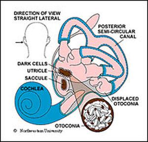 Ear rocks are small crystals of calcium carbonate called "otoconia" which collect in the inner ear. Epley Maneuver, Vertigo Exercises, Vertigo Symptoms, Vestibular System, Inner Ear, Post Traumatic, Calcium Carbonate, Head And Neck, Migraine