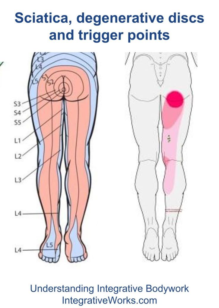 fi-sciatica-and-trigger-points Sciatic Nerve Relief, Sciatic Nerve Pain Relief, Sciatica Stretches, Sciatica Symptoms, Back Health, Sciatica Exercises, Sciatica Relief, Sciatica Pain Relief, Pinched Nerve