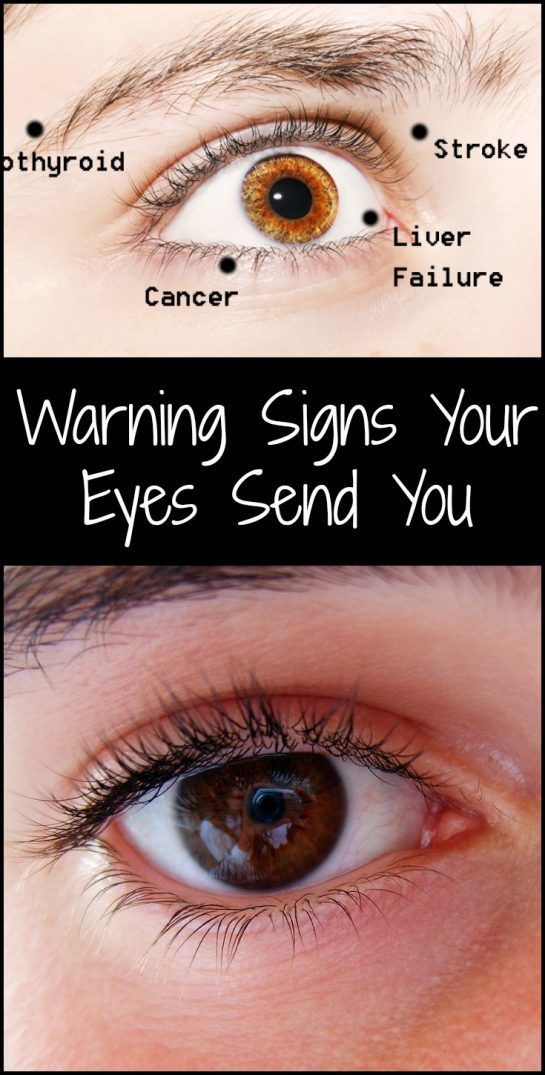 Warning Signs Your Eyes Send You Signs Of Iron Deficiency, Migraine Aura, Overactive Thyroid, Computer Vision Syndrome, Liver Failure, Eyes Problems, Lose 40 Pounds, Eye Health, Warning Signs