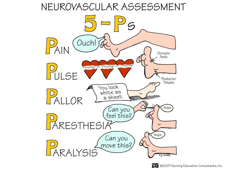 The 5 'P's of neurovascular assessment Nurse Notes, Nursing Information, Nursing Board, Nursing Assessment, Nursing Mnemonics, Nursing Student Tips, Pa School, Nursing School Survival, Nursing Life