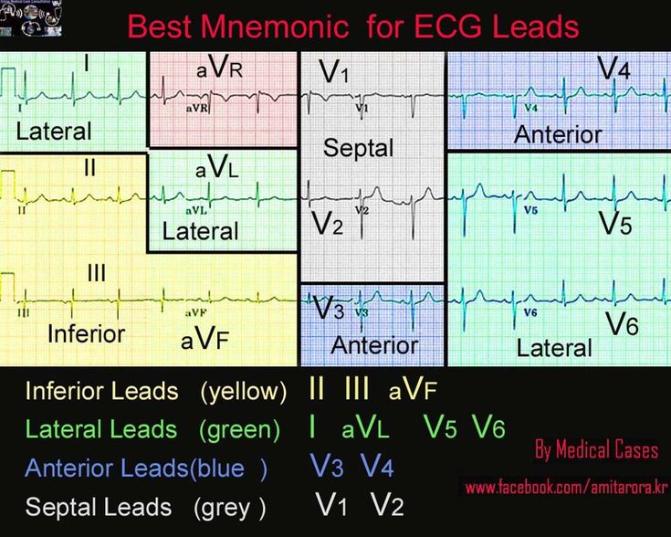 12 lead ECG Ekg Interpretation, Ecg Interpretation, Paramedic School, Nursing Mnemonics, Cardiac Nursing, Critical Care Nursing, Nursing School Studying, Nursing School Tips, Nursing School Notes