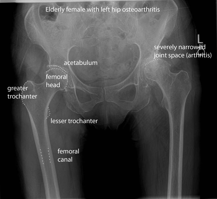 xray+images | AP-pelvis-female-osteoarthritis-anatomy Xray Images, Radiographic Anatomy, Diagnostic Radiography, Anatomy Of The Knee, Exam Images, Radiography Student, Medical Radiography, Rahul Dev, Physical Therapy School