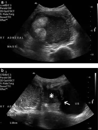 urinary bladder dermoid cyst Urinary Bladder, Medical Sonography, Diagnostic Medical Sonography, Ultrasound Pictures, Credit Card App, Radiology, Ultrasound, Medicine, Credit Card