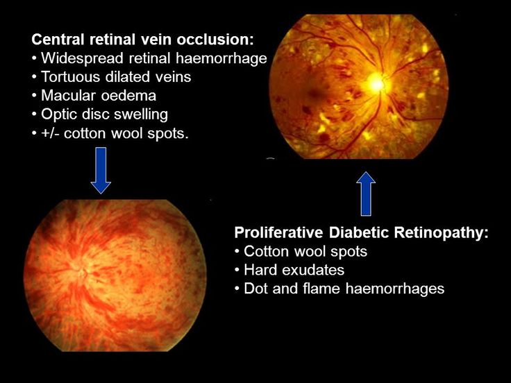 Image result for central retinal artery occlusion vs proliferative ...