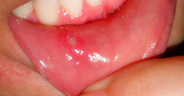 Remedies for Mouth #Ulcers  Mouth ulcers are also known as Canker Sores. They can be defined as a painful sore that occurs in the mouth. It can occur on the tongue, lips or gums and because of which it becomes difficult to swallow food and drink.  Mouth ulcers are usually yellow or white in color and have redness surrounding them. They usually occur due to reasons like eating lot of acidic or spicy foods, food allergies, poor dental hygiene, biting of the tongue or cheeks, stress, and even due n Mouth Blisters, Canker Sore Remedy, Swallow Food, Canker Sore, Cold Sores Remedies, Nutritional Deficiencies, Cold Sore, Odaiba, Digestion Problems