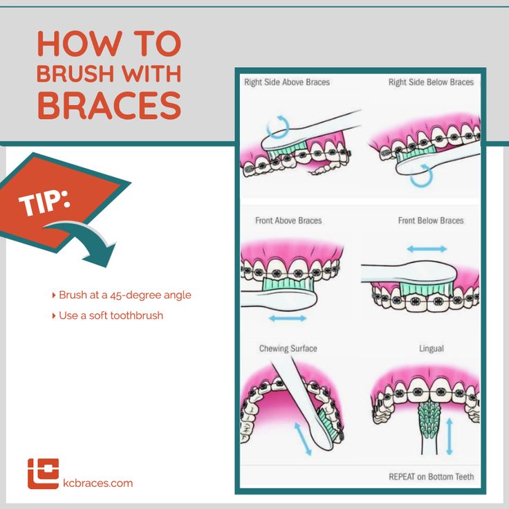 😎 Braces wearers, be sure to brush above and below braces at a 45 ...