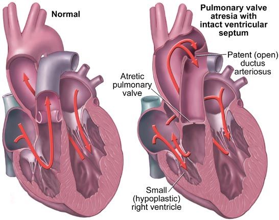 7 best Pulmonary Atresia images on Pinterest | Chd awareness ...