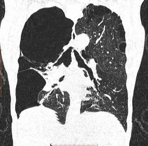 FINAL DIAGNOSIS Vanishing lung syndrome DIFFERENTIAL DIAGNOSIS LIST ...