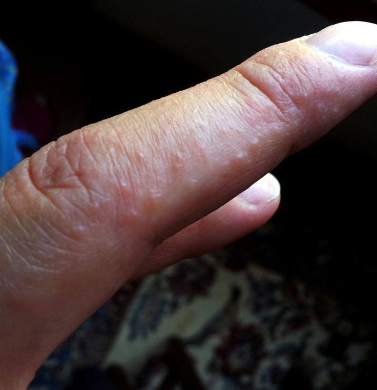 Dermatitis herpetiformis Omg that's what those are?! Skin Manifestation, Celiac Symptoms, Gluten Intolerance Symptoms, Gluten Allergy, Healing Remedies, Disease Symptoms, Gluten Sensitivity, Gluten Intolerance, Thyroid Health