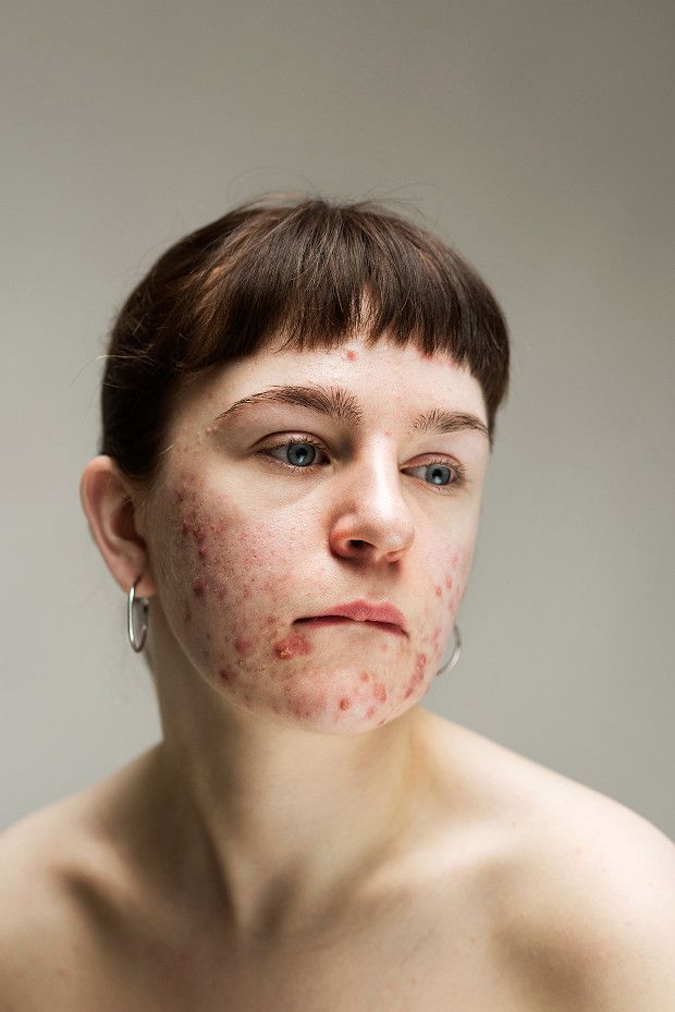 a woman with acne on her face