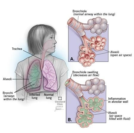 Pneumonia | Cleveland Clinic | Pneumonia, Pneumonia causes, What causes ...