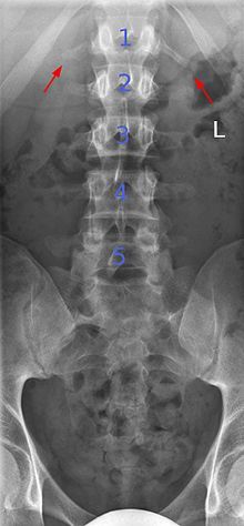 an x - ray shows the chest and ribs with arrows pointing up to indicate where it is