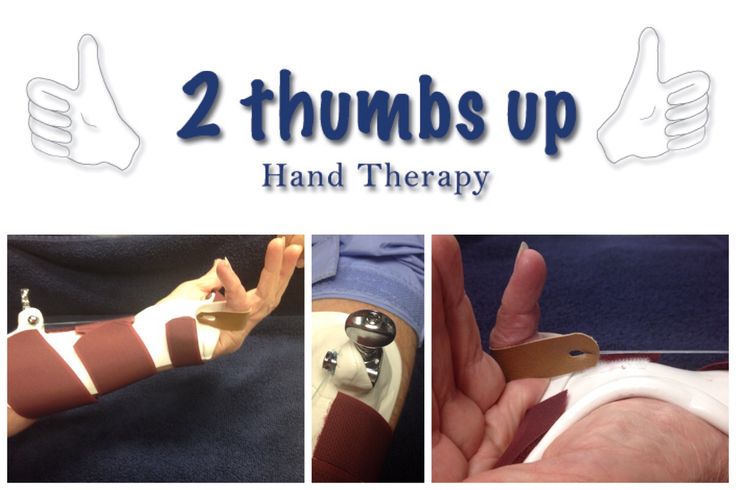 2 Thumbs Up Hand Therapy Custom Dynamic MCP flexion splint Hand Therapy, Celebrity Travel, Shape Of You, Travel Design, Occupational Therapy, Education Quotes, Child Development, Special Needs, Physical Therapy