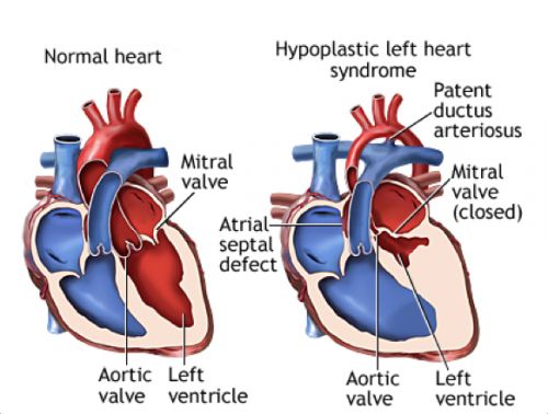 Cardiologie pédiatrique : un diagnostic porté 6500 ans plus tard ...