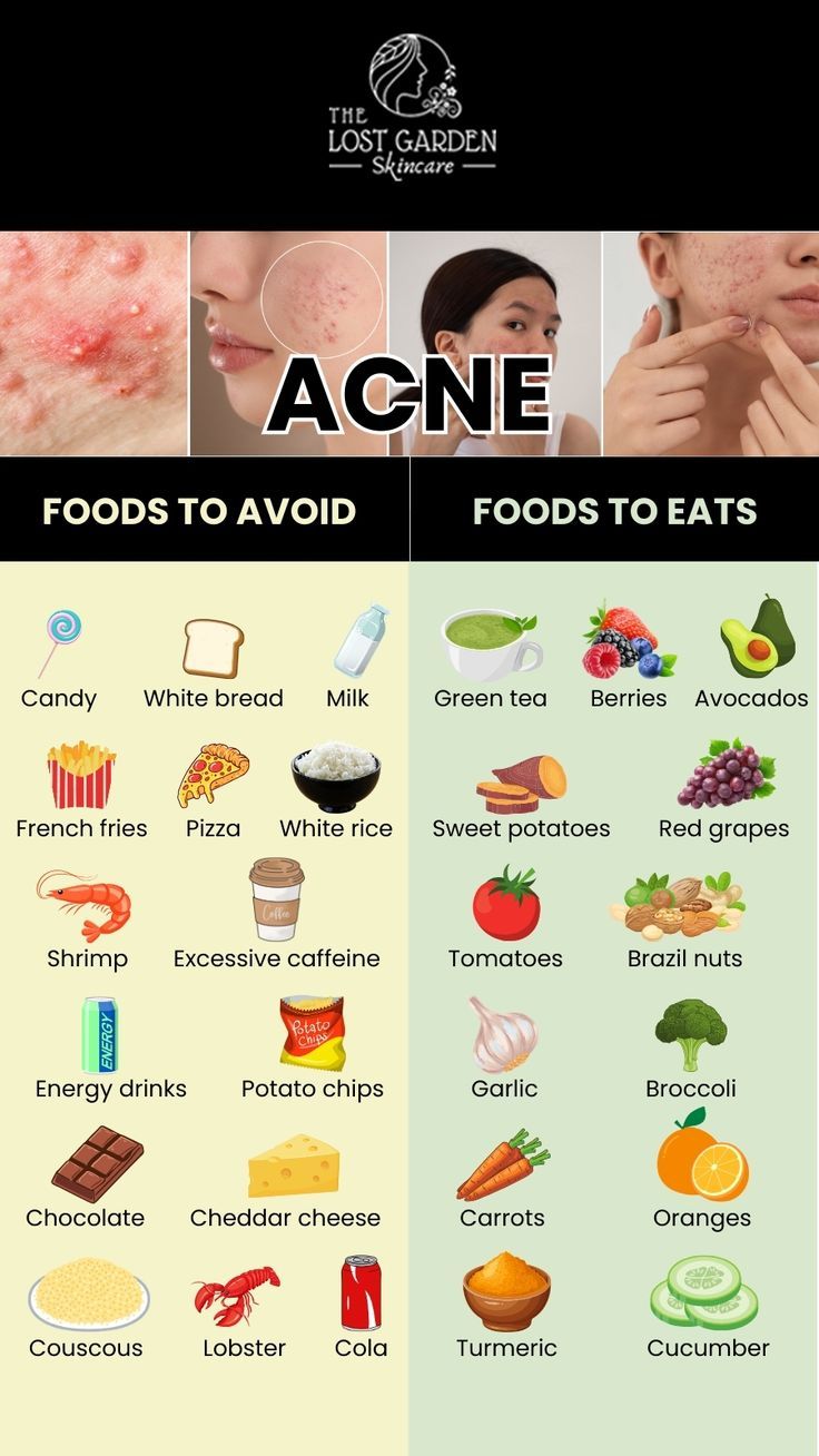 Want to fight acne through your diet? Find out the foods you should avoid and the ones you should include for healthier, acne-free skin. Visit our online shop for acne-fighting products and achieve clear skin! Food For Acne, Foods For Clear Skin, Clear Skin Diet, Acne Diet, Skin Diet, Acne Free Skin, Food To Eat, Clear Healthy Skin, Natural Acne