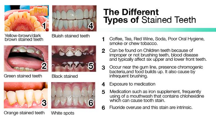 How To Get Rid Of Stained Teeth – beamglo Types Of Teeth, Whiten Your Teeth, Yellow Teeth, Tooth Sensitivity, Stained Teeth, Dental Procedures, Someone New, White Teeth, When You Know