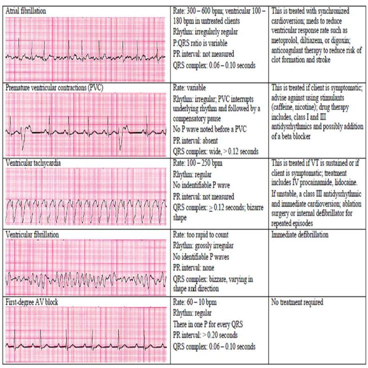 Printable Ekg Cheat Sheet