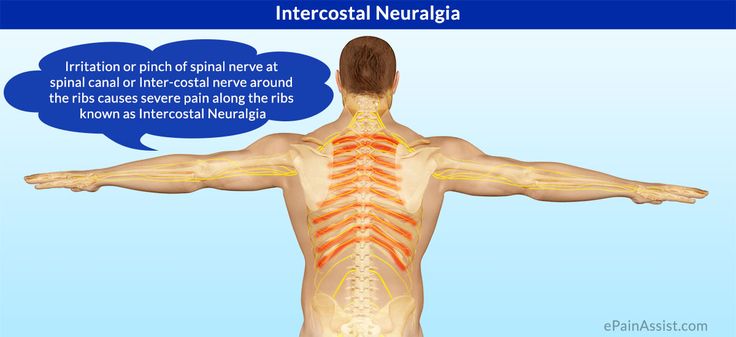 are there intercostal muscles in the back - Google Search Intercostal Neuralgia, Intercostal Muscles, Rib Pain, Manual Therapy, Spinal Nerve, Shoulder Surgery, Back Pain Remedies, Psoas Muscle, Upper Back Pain