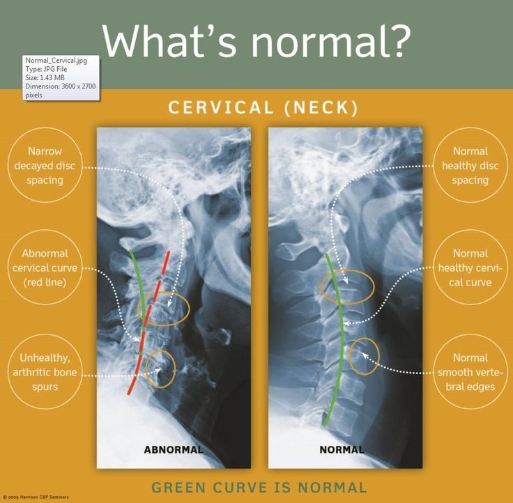 1. Normal_Cervical Cervical Lordosis, Musculoskeletal Disorders, Spinal Degeneration, Spinal Health, Cervical Spondylosis, Neck Problems, Disk Herniation, Literature Review, Spine Health