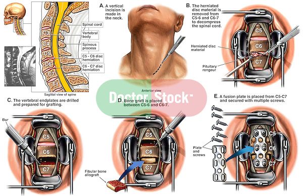 Spine Surgery - C5-6 and C6-7 Anterior Cervical Discectomy with Spinal Fusion and Plating Acdf Surgery, Spinal Fusion Surgery, Cervical Disc, Cervical Pain, Spinal Fusion, Bulging Disc, Disk Herniation, Spinal Surgery, Neck Surgery