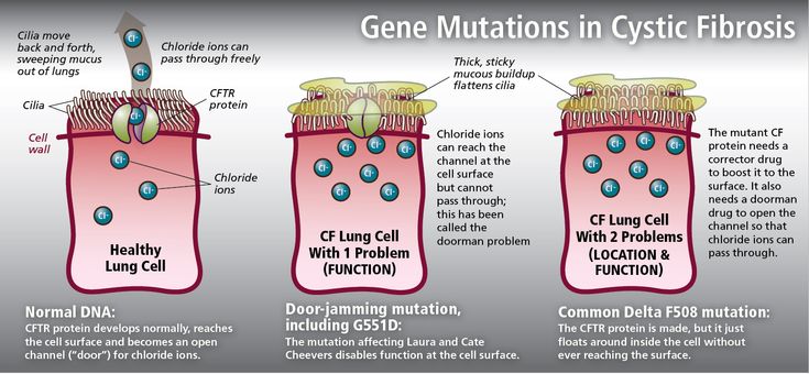 Cystic fibrosis is a genetic condition in which the lungs and digestive system become clogged with thick sticky mucus. Cystic fibrosis is a multi-system disorder that produces a variety of symptoms including: Persistent cough with productive thick mucus, Wheezing and shortness of breath. Salt Therapy, Persistent Cough, Creation Story, Genetic Disorders, Asthma Attacks, Cell Wall, The University Of Chicago, Respiratory System, Biochemistry