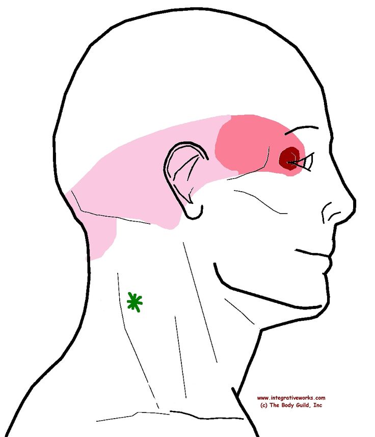 referral - splenius cervicis - C3 Headache Behind Eyes, Trigger Points Neck, Acupressure Headache, Punkty Spustowe, Forward Head Posture Exercises, Sinus Congestion Relief, Neck Ache, Natural Headache, Constant Headaches