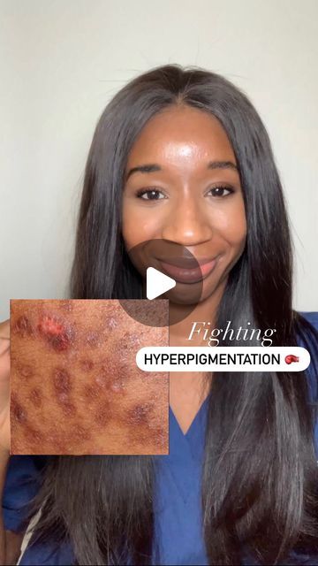 Vitamin C For Hyperpigmentation, Tyrosinase Inhibitors, Skin Lightening Products, Acne Hyperpigmentation, Post Inflammatory Hyperpigmentation, Acne Dark Spots, Keratosis Pilaris, Lighten Dark Spots, Acne Solutions