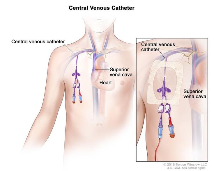 central catheter - Google Search Subclavian Vein, Catheter Insertion, Central Venous Catheter, Intravenous Fluids, Nursing School Essential, Interventional Radiology, Nurse Study Notes, Oncology Nursing, Acute Care