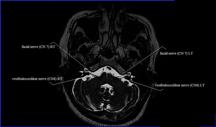 Cranial Nerves Mri