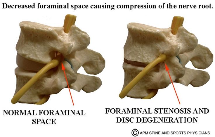 Lumbar Neural Foraminal Stenosis What is spinal stenosis? Foraminal Stenosis, Trapped Nerve, Emt Study, Cauda Equina, Cervical Disc, Sciatica Symptoms, Spinal Decompression, Causes Of Back Pain, Spinal Injury