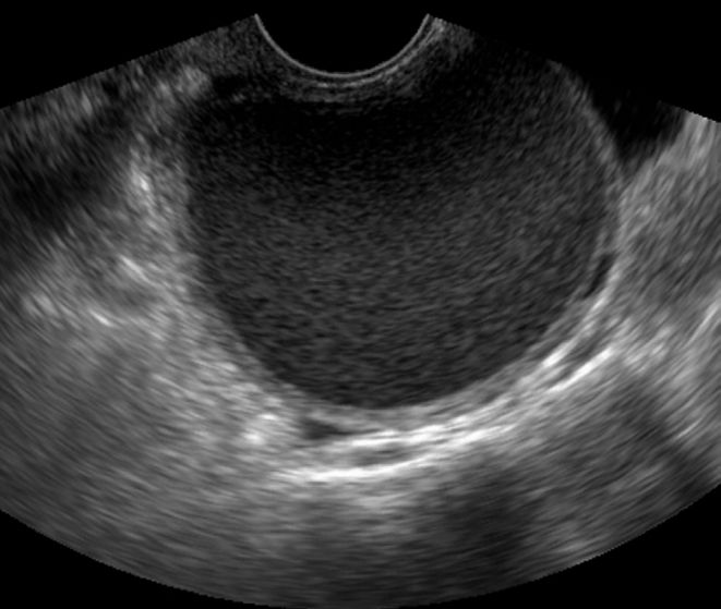 Endometrioma occurs in the ovary where ectopic endometrial tissue is implanted. The characteristic US features of endometrioma are homogeneously diffuse low-level echoes in the cyst, compromising the so called ground-glass appearance, which is indicative of chronic repetitive hemorrhages within the cyst (Fig. 4) [17]. However, less than 15% of endometrioma have atypical findings, such as fluid-fluid level, hyperechoic mural irregularity, heterogeneity, or calcification (Fig. 5) [18,19]. In a... Language Journal, Medical Ultrasound, Pattern Recognition