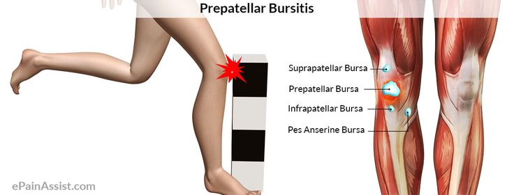 Prepatellar Bursitis or Beat Knee or Carpet Layer's Knee Read: http://www.epainassist.com/sports-injuries/knee-injuries/prepatellar-bursitis-or-beat-knee-or-carpet-layers-knee Layering Carpet, Medical Terms, Types Of Yoga, Sports Injury, Kundalini Yoga, Knee Injury, Yoga Set, Yoga For Beginners, Back Pain