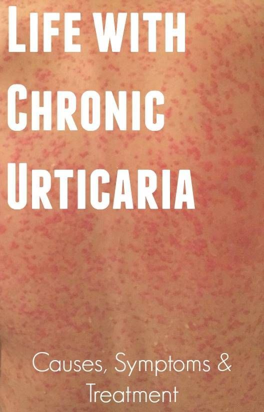 Article on Chronic Urticaria from a fellow sufferer who hasn't yet found relief.  AJ Ferguson is also in the CU Support Group on FaceBook.  She's about to try Xolair.  Hmmm.....might need to ask about it.  :-) Hives Remedies, Chronic Hives, Facial Warts, Itchy Rash, Auto Immune, Sweat Gland, Autoimmune Disease, Support Group, Skin Conditions