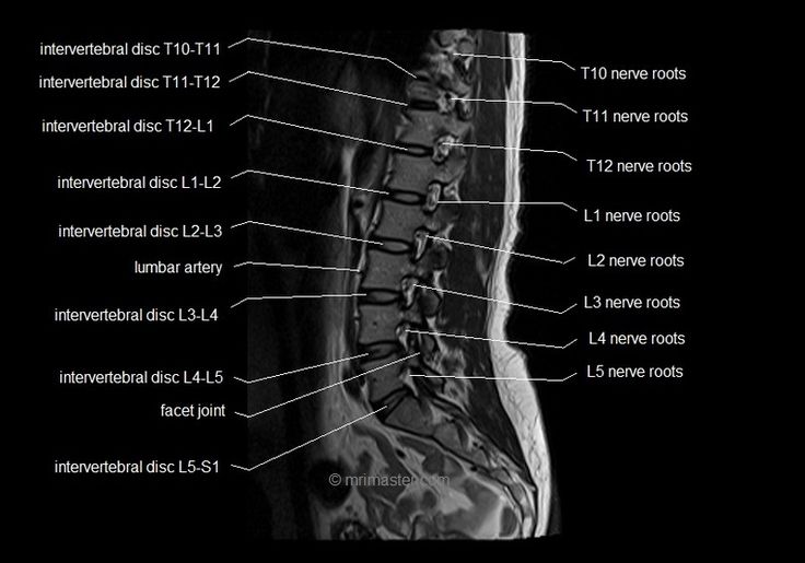 MRI spine anatomy | free MRI lumbar spine sagittal cross sectional ...