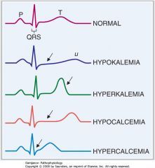 hypokalemia hyperkalemia ecg - Google Search Nursing Infographic, Electrolyte Imbalance, Paramedic School, Vet Medicine, Nursing Mnemonics, Medical Student Study, Cardiac Nursing, Nursing School Survival, Medicine Student