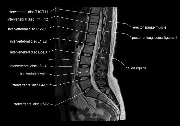 MRI lumbar spine sagittal cross sectional anatomy image 5 | Mri ...