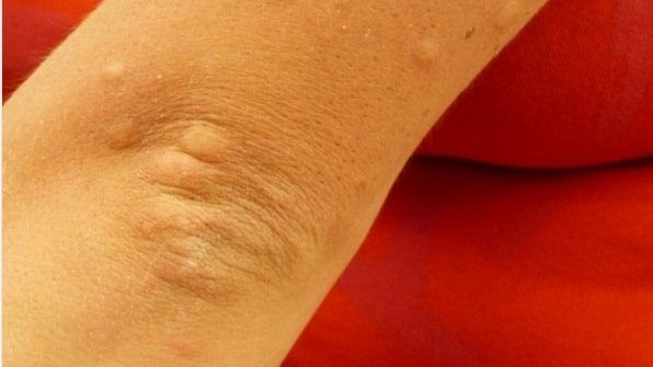 #Bumps on #elbows? A critical look at the bumps that occurs at the elbows and #knees that are white or red in color, #itchy and not itchy Itchy Rash, Acne Causes, Personal Hygiene, Food Diary, My Health, Superfoods, My Eyes, Bump, Allergies