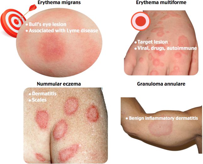 Erythema migrans Erythema multiforme Nummular eczema Granuloma annulare Erythema Multiforme, Aquaponics System Design, Granuloma Annulare, Acute Care Nurse Practitioner, Dermatology Nurse, Vertical Aquaponics, Physician Assistant School, Notes Nursing, General Medicine