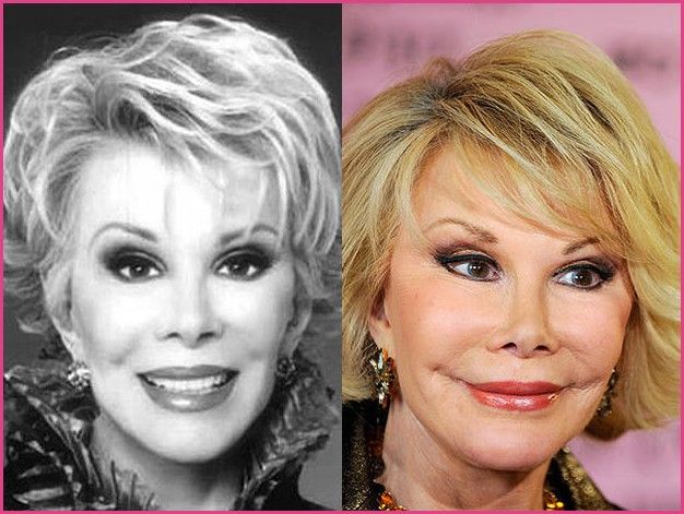 Celebrity Plastic Surgery Disasters? - Photo 1 - Pictures » Plastic Surgery Before And After #plasticsurgery #beforeandafter #celebrities #celebrity Botox Forehead, Bad Celebrity Plastic Surgery, Face Plastic Surgery, Extreme Plastic Surgery, Famous Blondes, Bad Plastic Surgeries, Plastic Surgery Fail, Plastic Surgery Photos, Plastic Surgery Gone Wrong